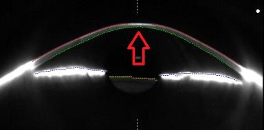 Normal Cornea Shape