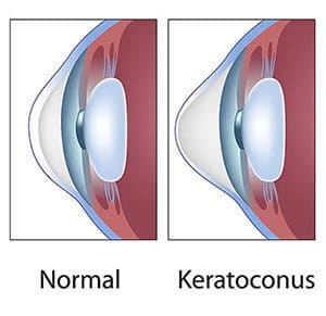 Keratoconus