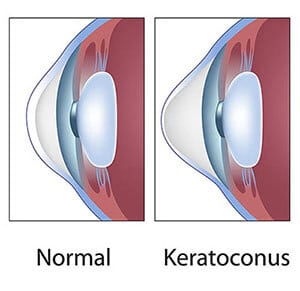 Keratoconus Treatment Houston