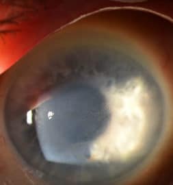 Corneal Swelling