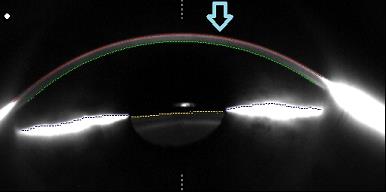 Keratoconus Cornea