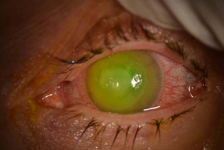 Corneal ulcers in Houston