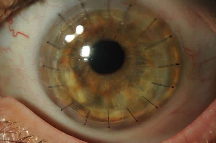 Corneal Disease