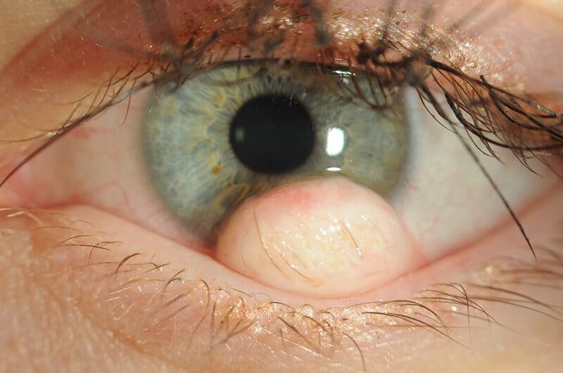 Before corneal surgery