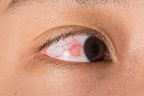 What is a pinguecula? What is a pterygium? - Mark C. Vital, M.D.