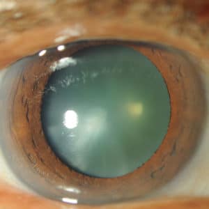 Eye Before Cataract Surgery