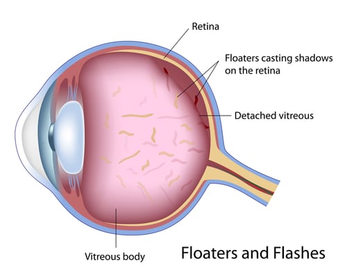 flashes and floaters treatment houston
