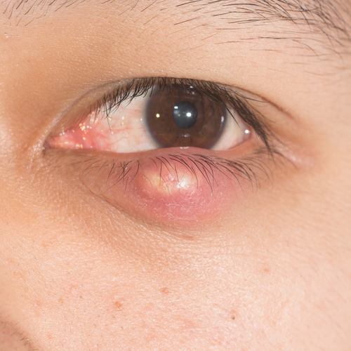 close up of chalazion