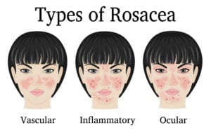 ocular rosacea