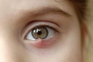 eye chalazion