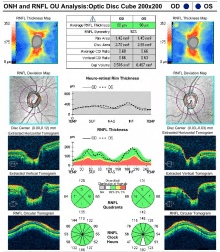 Optic Nerve OCT