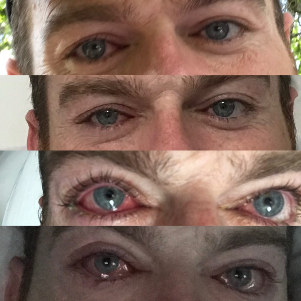 Close-up of eyes through worsening stages of viral pink eye
