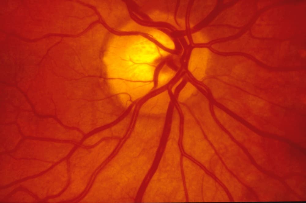 Optic Nerve OCT